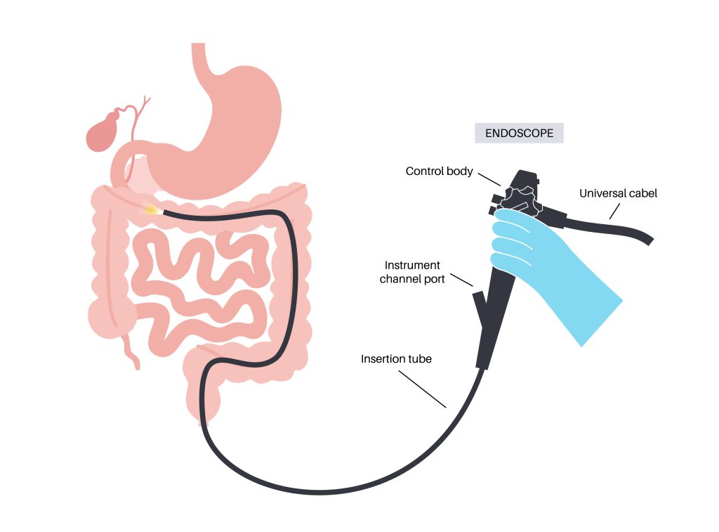 endoscopy vs colonoscopy procedure